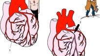 Angina pectoris – závažné onemocnění srdce