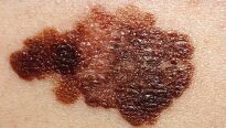 Nebezpečný melanom kůže