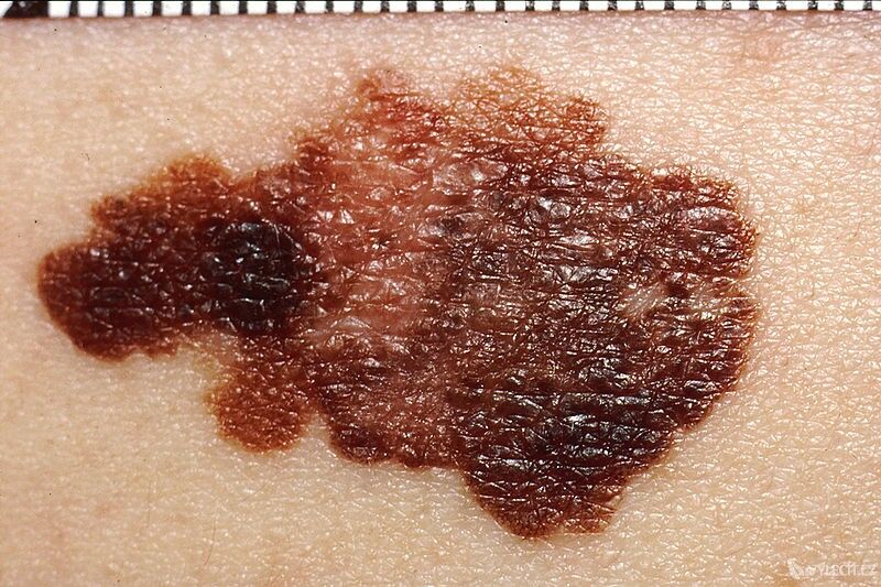 Maligní melanom kůže bez pravidelných okrajů, autor: Kuebi
