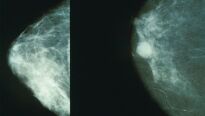 Rakovina prsu - odhalte ji včas