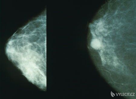 Normální tkáň vlevo, tkáň nakažená rakovinou vpravo, autor: Morning2k