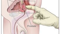 Rakovina prostaty - strašák všech mužů