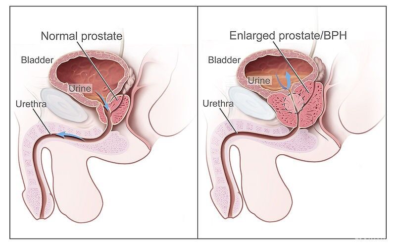 Vlevo – správná funkce, nezvětšená prostata, Vpravo – zvětšená prostata, autor: Stevenfruitsmaak