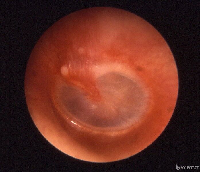 Začínající zánět středního ucha, autor: B. Welleschik