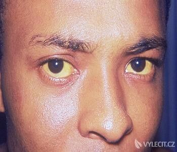 Příznakem žloutenky typu A je zažloutlé bělmo očí. Autor: Centers for Disease Control and Prevention