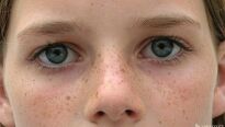 Pigmentové skvrny v obličeji – noční můra každé ženy Pigmentové skvrny v obličeji – noční můra každé ženy