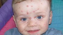 Plané neštovice – příznaky, komplikace a léčba