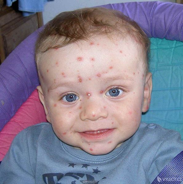 Plané neštovice je onemocnění dětí a projevuje se pupínky a vysokou teplotou, autor: Giro720