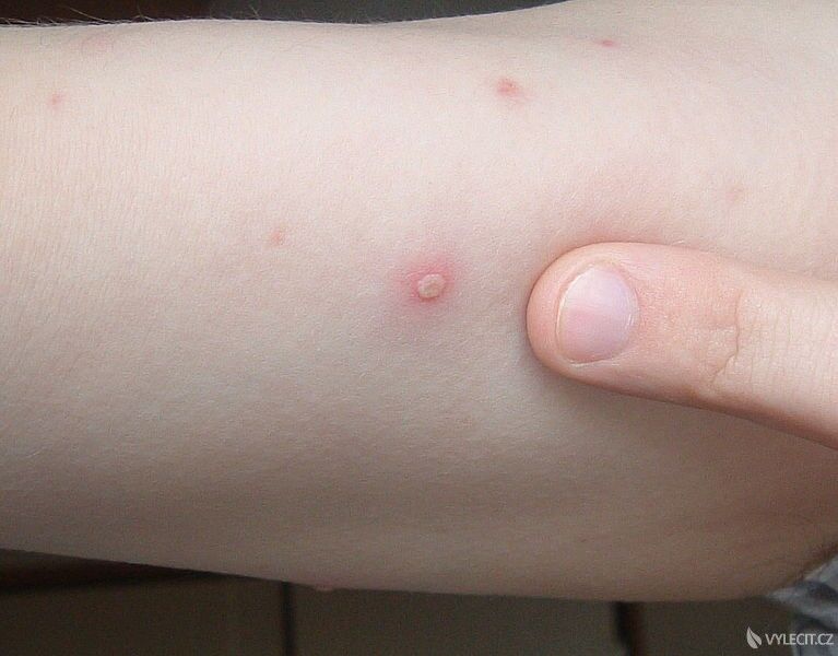 Plané neštovice se projevují postupným přibýváním puchýřků, autor: Zeimusu