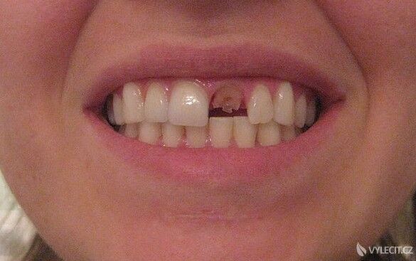 Třetí fází paradentózy je vypadávání zubů, autor: mbkepp