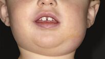 Příušnice – jak na dětskou virovou nemoc? 