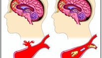 Mozková mrtvice – příznaky a následky nemoci