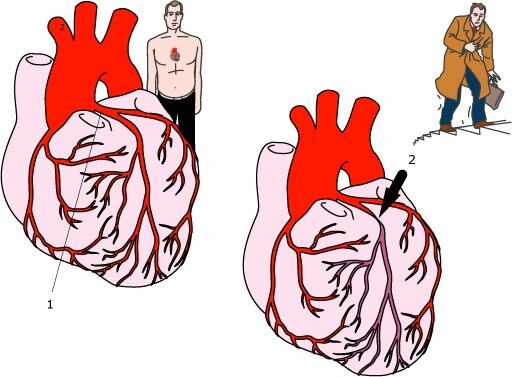 Angina pectoris je vážné onemocnění srdce, které může vést k infarktu, autor: medicalclinique