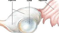 Cysty vaječníků – příznaky a léčba