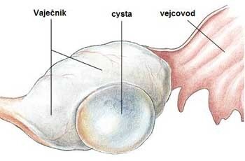Cysta na vaječníku je způsobena rozpadem hormonální soustavy, autor: prolecina