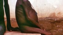 Podvýživa – smrtelná hrozba nejenom v Africe