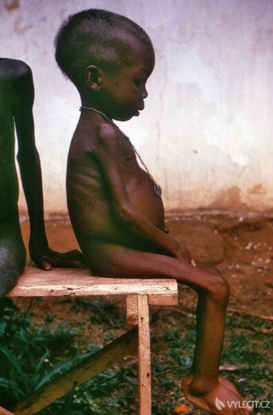 Podvýživa je jedním z největších problému lidstva, autor: decatelum