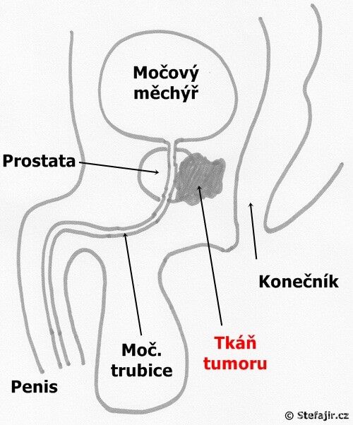 Rakovinu prostaty lze zachytit včas, autor: stefajir