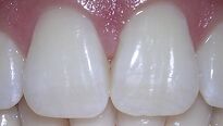 4 chyby v péči o zuby - děláte je také?