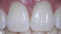 Zuby jako perličky aneb jak (ne)bělit?
