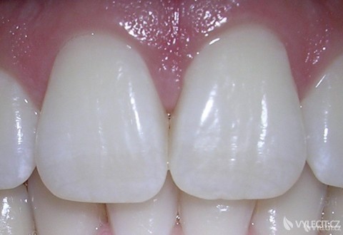 Jak vybělit zuby?, autor: 06centralincisors
