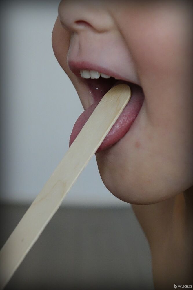 Bílý povlak na mandlích a jazyku je příznakem angíny.